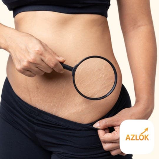 Anti Stretch Marks Extract Oil Blend - Image 1